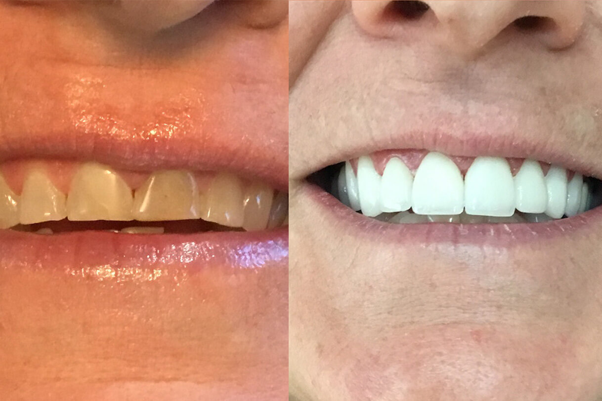 SmileMakeover1